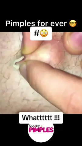 #pimple #medical #horror #blackhead #bigpimple #pimpleremoval #disgusting #pimplepop #cystexplosion #squeeze #squeezeyuk #skincare #acnetreatment #acne #pimples #satisfying #abscess #verysatisfying #whiteheads #cyst 