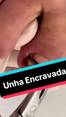 Desencravando unha com espicula gigantesca #unhaencravada #satisfatorio #satisfyingvideo #unhaencravada2021 #unhaencravada2022 #nail #unhaencravadasatisfatorio 