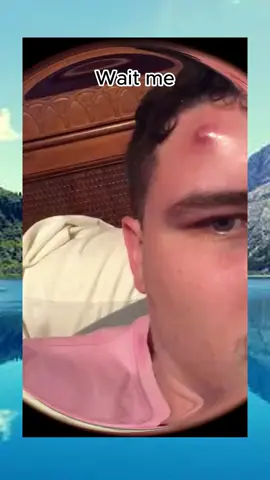 squeezeuk popping acne pimple satisfyin abscess removal viral (639)
