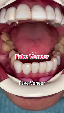 Tolong jaga gigi nak mulut anda. Fake veneer tak buat gigi kita cantik pun sebenarnya. #fyp #tiktok #tranding #veneers #fakeveneers 