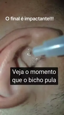 O final 😱! #earwaxremoval #clean #limpeza 
