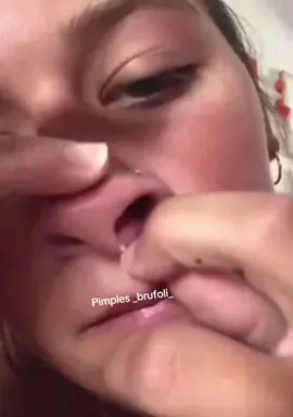 #brufoli #cravos #blackhead #zit #pimples_brufoli_ #asmr #pimples #popper #zits #acne #pimplepop #pimples_brufoli #pimple #popping 