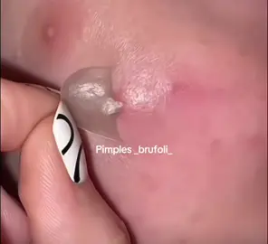 #brufoli #cravos #blackhead #zit #pimples_brufoli_ #asmr #pimples #popper #zits #acne #pimplepop #pimples_brufoli #pimple #popping 
