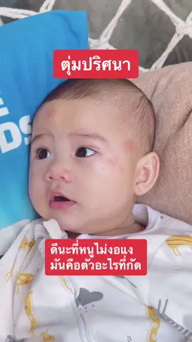 แม่จิตตกล้ะ1  มันบวมเกิน มีน้ำหนองด้วย #ผื่น  #ตุ่ม  #แพ้คันเด็ก ผื่นแดง 