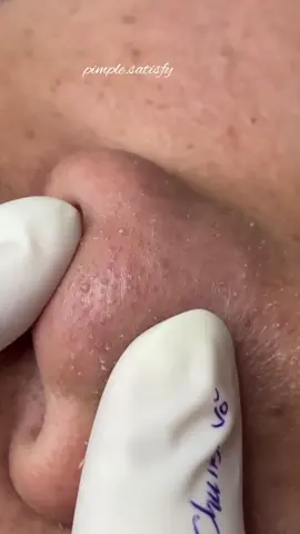 8 in 1 Stainless Steel Acne Kit Facial Cleaning Tools Set Pimple Blackhead Tweezer Needle Set Face Care#tiktokaffiliate #blackheadsremover 