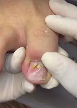 Descolamento  por trauma na unha Retirada de toda parte solta e drenagem de todo exsudato (pus) por baixo da unha. #unhas  #podologa  #unhainflamada  #dor 