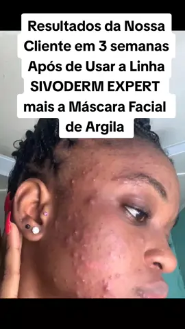 SIVODERM EXPERT +  Máscara Facial de Argila 20 mil kwanzas WhatsApp ☎️🇦🇴 952*226*563 Estamos localizados em Luanda Bairro Morro Bento ou seja na Multiperfil #CuidadosDaPele  #SkinCare  #resultados30dias  #viraltiktok  #luandatiktok  #Angolatiktok  #angola🇦🇴portugal🇵🇹brasil🇧🇷 