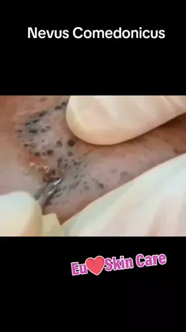#nevuscomedonicus #extractions #extractionsatisfaciton #blackheadsremoval #blackheadsextractions #cleaning 