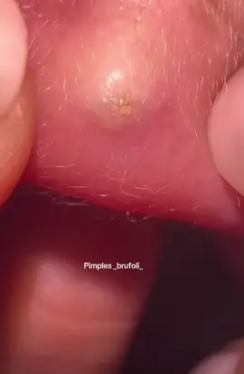 #brufoli #cravos #blackhead #zit #pimples_brufoli_ #popper #acne #zits #pimplepop #pimples_brufoli #pimple #popping #asmr #pimples 