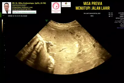 Vasa Previa Pembuluh Darah plasenta menutupi jalan lahir... #drwikuandonotopo #drwiku_andonotopo #polikandunganekahospitalbsd #fetomaternalekahospitalbsd #usgfetomaternalekahospitalbsd #konsultanfetomaternalekahospitalbsd #ekahospitalbsd #ekahospitalcibubur #ekahospitalbekasi #ekahospitalpekanbaru #fetomaternalbekasi #fetomaternalcibubur #fetomaternal #konsultanfetomaternal #usg #usg4d #perkembanganbayi #perkembanganjanin #fyp #melahirkannyaman #melahirkannormal #melahirkancesar #janin #lahiran #melahirkan #melahirkansc #melahirkanalami #usgfeto #usgfetomaternal #vasaprevia 