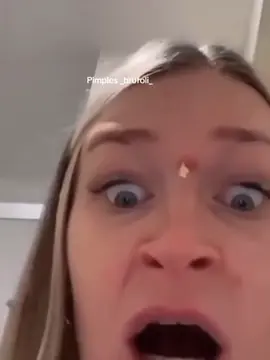 #brufoli #cravos #blackhead #zit #pimples_brufoli_ #popper #acne #zits #pimplepop #pimples_brufoli #pimple #popping #asmr #pimples 