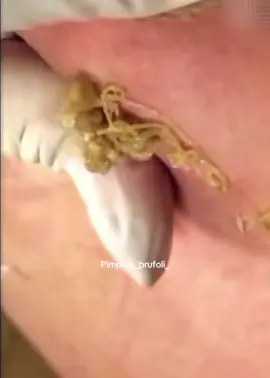 #brufoli #cravos #blackhead #zit #pimples_brufoli_ #popper #acne #zits #pimplepop #pimples_brufoli #pimple #popping #asmr #pimples 
