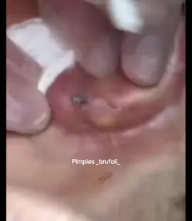 #brufoli #cravos #blackhead #zit #pimples_brufoli_ #popper #acne #zits #pimplepop #pimples_brufoli #pimple #popping #asmr #pimples 