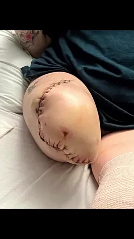 Almost 2 years ago i was hit and ran over by a garbage. This is me from start to end, well it aint over yet #amp #amputee #amputeelife #amputeegirl #baka #mystory #mylife 