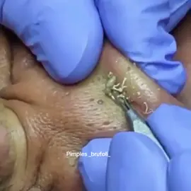 #brufoli #cravos #blackhead #zit #pimples_brufoli_ #popper #acne #zits #pimplepop #pimples_brufoli #pimple #popping #asmr #pimples 