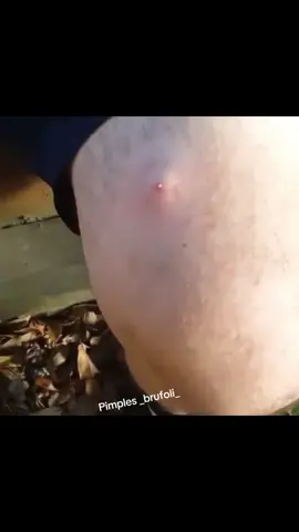 #brufoli #cravos #blackhead #zit #pimples_brufoli_ #popper #acne #zits #pimplepop #pimples_brufoli #pimple #popping #asmr #pimples 