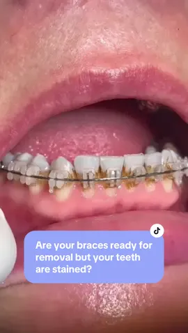 Cleaning around your brackets whilst in orthdontic treatment can be a bit more trick. We always give instructions on how best to do this and recommend regular hygiene appointments but sometimes teeth and brackets can get stained. Watch how we clean and freshen up this patient’s teeth at her brace removal by combining a thorough dental hygiene appointment!#beautiful #teethtip #bracetips #cleanteeth #dirtytoclean #hygieneappointment #dentalhygiene #bracesoff #bracestok #bracestransformation 