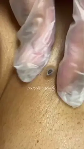 big blackhead 🤗 #relaxing #relax #foryoupage #foryou #tiktoklongs #satisfyingvideo #satisfying #satisfying #pimplepop #pimple 