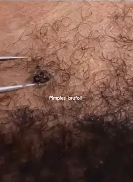 #brufoli #cravos #blackhead #zit #pimples_brufoli_ #popper #acne #zits #pimplepop #pimples_brufoli #pimple #popping #asmr #pimples 