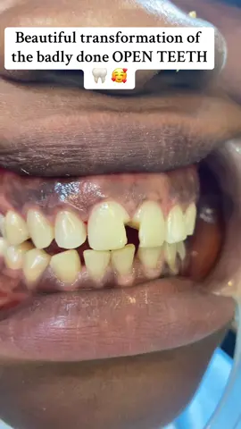 Beautiful transformation  #fypシ #fupage #teeth #compositeveneers #teeth 