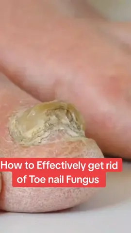 How to effectively get rid of toe nail fungus NATURAL RECIPE TO ELIMINATE TOENAIL FUNGUS #nailfungus #toenailfungus #fungus #nails #naturalremedy #healthy #womenshealth#600leilah #worldwide #southafrica #uganda 
