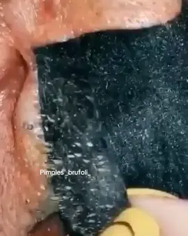 #brufoli #cravos #blackhead #zit #pimples_brufoli_ #popper #acne #zits #pimple #popping #asmr #pimples_brufoli #pimples 