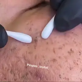 #brufoli #cravos #blackhead #zit #pimples_brufoli_ #popper #pimple #acne #zits #popping #asmr #pimples_brufoli #popper 