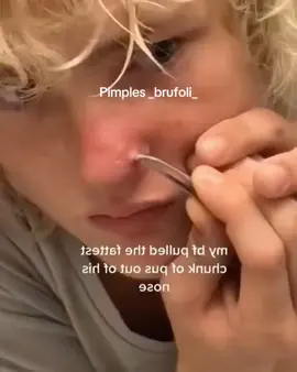 #brufoli #cravos #blackhead #zit #pimples_brufoli_ #popper #pimple #acne #pimples_brufoli #popping #zits #asmr #pimples #pimplepop 