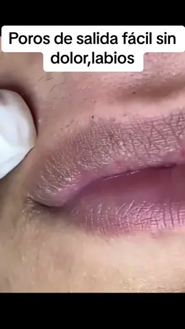 #Extracción #poros #granos#pelo #espinillas #limpiezafacial #acne #tratamientos 