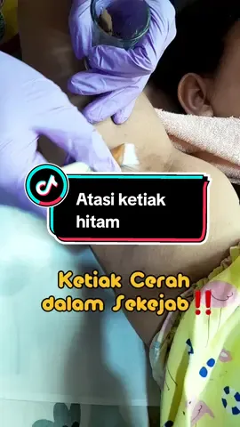 Yuk, cobain treatment Peeling Ketiak biar bebas dari keti hitam. Ketiak langsung cerah dalam sekejab‼️ #evanticlinic #klinikkecantikanpati #klinikkecantikanrembang #chemicalpeeling #skincarepati #hairremoval #laserketiak #beautyclinicpati #lasertreatment #infopati #infopatiupdate 