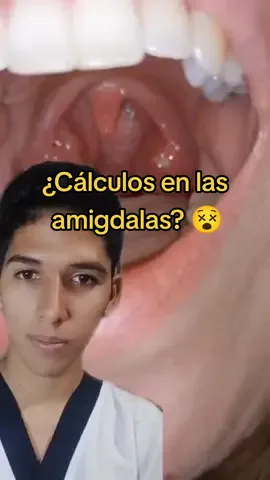 Sabes cómo eliminar los #tonsilolitos #calculosamigdalinos #higienebucal #salud #paratii #fypp #enfermeria #medicina 