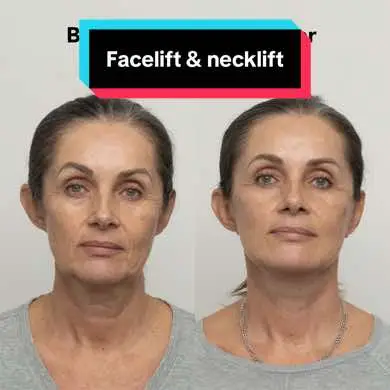 Photos after were taken 18 days after surgery👌🏻 What do you say?😉 📲 If you want to make an appointment, contact us at info@v-clinic.cz #facelift #necklift #deepfacelift #deepnecklift #plasticsurgery #plasticsurgeon #beforeandafter #transformation 