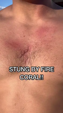 FIRE CORAL HURTS SO BAD 😭 #firecoral #stungby #rash 