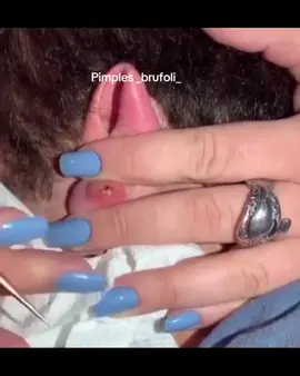 #brufoli #cravos #blackhead #zit #pimples_brufoli_ #popper #pimple #acne #pimples_brufoli #popping #zits #asmr #pimples #pimplepop 