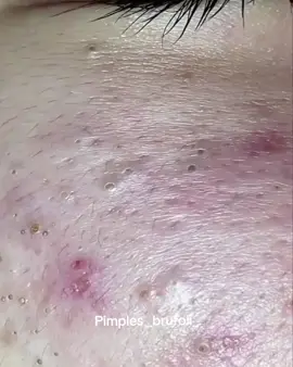 #brufoli #cravos #blackhead #zit #pimples_brufoli_ #popper #pimple #acne #pimples_brufoli #popping #zits #asmr #pimples #pimplepop 
