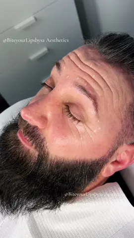 #botox #antiwrinkle #toxin #toxinabotulinica #nowrinkles #smooth #frownlines #frontalis #forehead #riduri #london #aesthetics #injections #maletreatment 