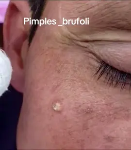 #brufoli #cravos #blackhead #zit #pimples_brufoli_ #popper #pimple #acne #pimples_brufoli #popping #zits #asmr #pimples #pimplepop 