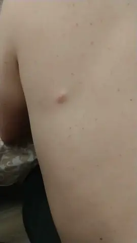 My dad finally had his cyst removed #pimple #fyp #pop #satisfying 