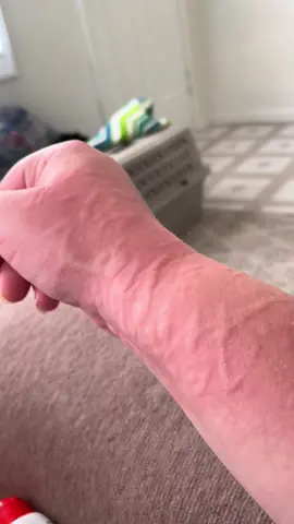 should i make this a series? 🤦🏻‍♀️ #Dermatographia #dermatographiacheck #dermatographiaproblems #dermatographiaawareness #fyp #fypシ #foryou #viral #skin #skincondition 