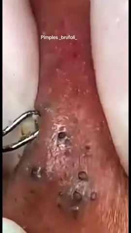 #brufoli #cravos #blackhead #zit #pimples_brufoli_ #popper #pimple #acne #pimples_brufoli #popping #zits #asmr #pimples #pimplepop 