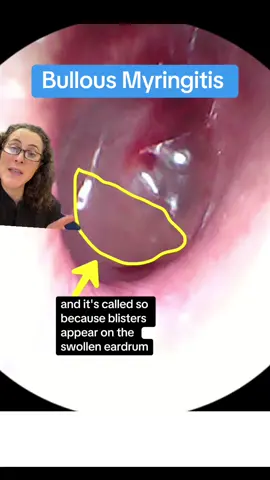 #greenscreen 🙉😢:   Bullous Myringitis is a type of ear infection that is extremely painful.  This is because the ear drum is loaded with nerve endings.  So if the ear drum is swollen with blisters it will cause a lot of pain! ⚠️  it's usually caused by severe congestion from untreated allergies or a bad cold. 🩺👩🏻‍⚕️ Please see an ENT doctor if you think you have this. 🏆🥇 thanks to all who participated in Guess The Diagnosis! ✍️ Have an idea for the next Guess The Diagnosis!  Comment below or DM me! #earpain #congestion #myringitis  #bullousmyringitis #earinfection  #eardrum      #entdoctor  