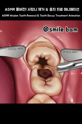 #애니메이션 #케어 #사랑니 #충치 #asmr #soonent #care #satisfying #wisdomtooth #cavity 