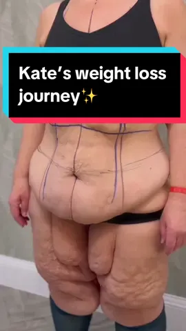 Her reaction is so heart warming 🥹 #weightloss #fdltummytuck #tummytuckjourney #tummytucksurgery #weightlossjouney 