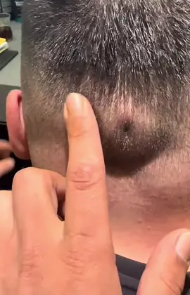 #brufoli #cravos #blackhead #zit #pimples_brufoli_ #popper #pimple #acne #pimples_brufoli #popping #zits #asmr #pimples #pimplepop 