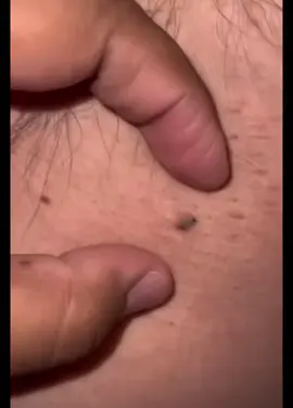 #brufoli #cravos #blackhead #zit #pimples_brufoli_ #popper #pimple #acne #pimples_brufoli #popping #zits #asmr #pimples #pimplepop #fyp #foryou #zitate 
