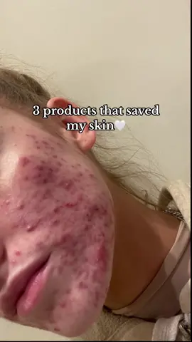 My favourite products for my skin🤍 (fyi I also had to do a lot of stress/ gut/ hormone healing too) #acne #acnetreatment #acnejourney #cysticacne #hormonalacne #acnescars #acneskin #acneproneskin #spots #acneskincare 
