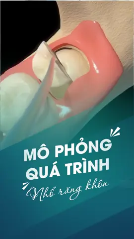 Mô phỏng quá trình nhổ răng khôn #nhakhoa #nhakhoahanseoul #dental 