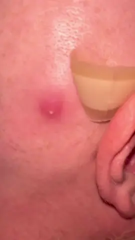 Popping this on the back of my husbands head #pimple #fyp #pop #satisfying 