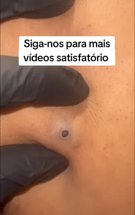 EXTRAÇÃO MAIOR CRAVO DO MUNDO #TIKTOKVIRALVIDEOS #TokDoEnem #INDIACRAVOS #GIGANTE #ESPINHAS #ACNES #REMOVAL #INFLAMADA #LIMPEZADEPELE #CRAVOS #REMOÇAODECRAVOS #ACNESKINCARE 