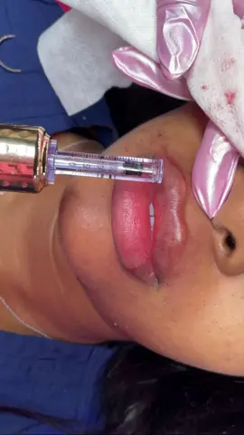 Attention everyone! [ MUST READ CAPTION ] Next time someone tries to tell you that achieving beautiful lips without needles is impossible, show them this Video 💓👌🏽   Get ready to witness the power of innovation as we reveal how needle-free techniques can help you achieve those gorgeous, plump, and enviable lips! This revolutionary technique allows you to achieve the lips of your dreams without any discomfort or downtime! Following @bossslayy you’ll witness the application of safe, high-quality HA & products, specifically designed for those who want to enhance their pout without any invasive procedures! These perfected techniques provide a natural-looking, plumping effect that will leave your lips feeling hydrated and irresistibly kissable!  ✨ So, let’s debunk the myth that beautiful lips can only be achieved through needles! This game-changing technique provides a safe, non-invasive alternative that anyone can enjoy. It’s time to celebrate self-expression and embrace the beauty options available to us in this modern age! 🎉🌈 🔥 Share this video with all your friends, family, and anyone who doubts the possibility of needle-free transformations! Let’s spread awareness and empower everyone to feel confident and beautiful in their own unique way!  👉 Stay tuned for more incredible videos showcasing how beauty and self-expression have evolved for the better! Remember, you deserve to feel amazing in your own skin, and there’s a solution out there for every beauty desire! 🌟💄 #slaytheday #lipfillersmiami #lipplump #liphydration #bossup #NeedleFreeBeauty #LusciousLips #BeautyRevolution #SelfExpression #ModernTechniques #NonInvasiveBeauty #ConfidenceIsKey #beauty #perfectlips #baddie #booknow #linkinbio #foryoupage 